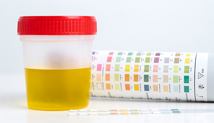 نتایج آزمایش ادرار